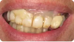TeethNow Dental Implant Centers-Untitled design (34)