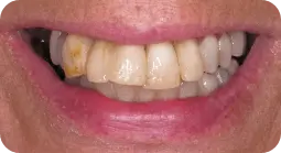 TeethNow Dental Implant Centers-before-1