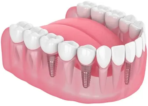 TeethNow Dental Implant Centers-smile-image