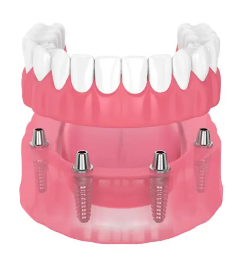 TeethNow Dental Implant Centers-3d render of removable full implant denture