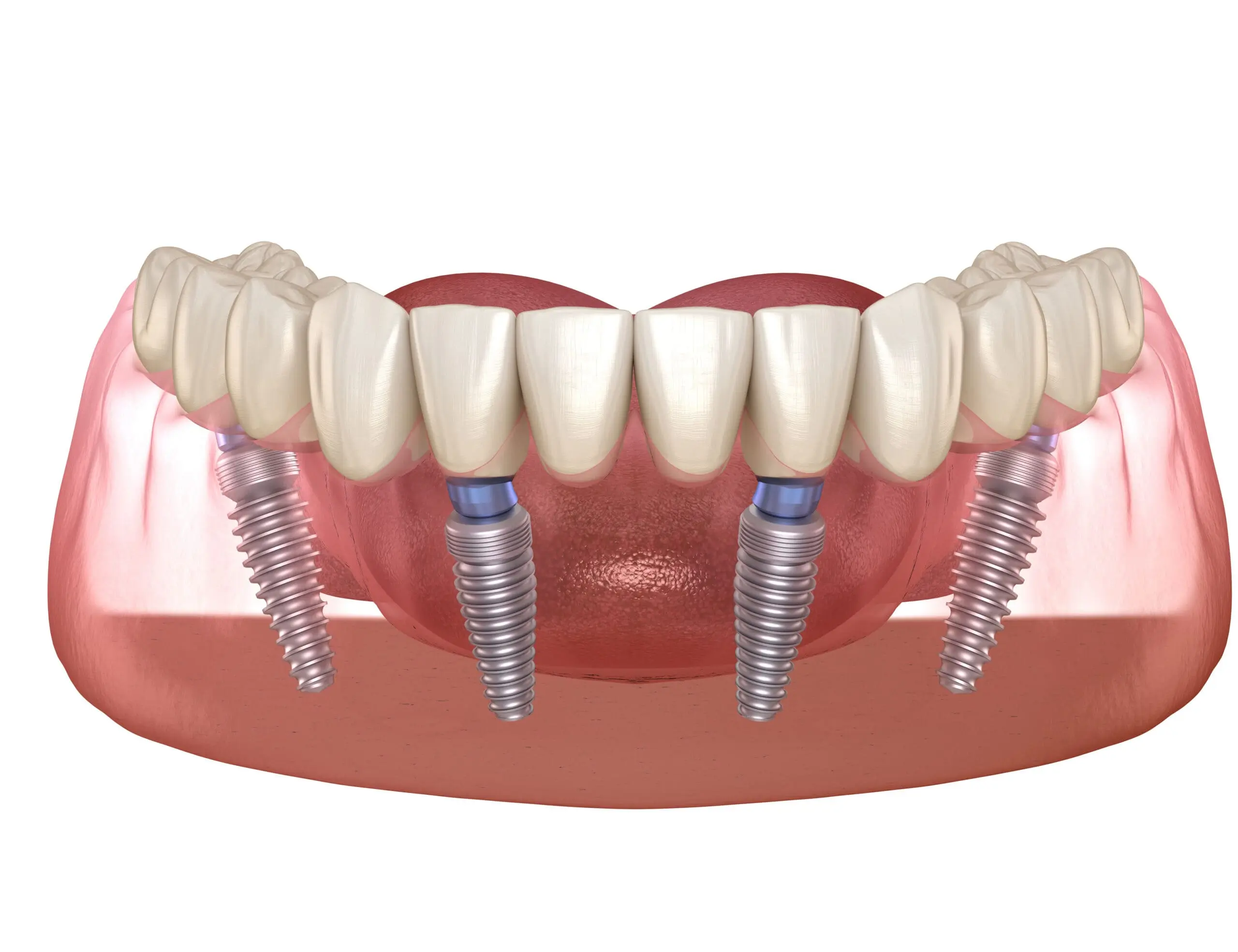 TeethNow Dental Implant Centers-Mandibular prosthesis All on 4 system supported by implants. Medically accurate 3D illustration of human teeth and dentures concept