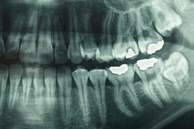 Smile in a Day™-dental-xray-2-825×550