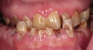Brian Prutkin's All-On-4 Transformation-before-teeth-bp-300×161