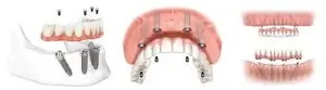 All-On-Four Procedure-dental-implants-all-on-four-midtown-nyc-1-300×83