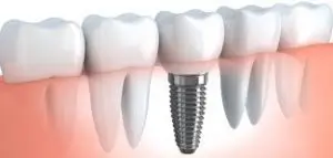 Smile In a Day - Same Day Dental Implant Treatment-download-300×143