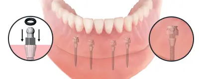 Mini Dental Implants-mini-dental-implants-1