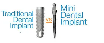 Mini Dental Implants-mini-vs.-traditional