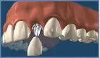 Smile In a Day - Same Day Dental Implant Treatment-siad1-2