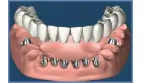 Smile In a Day - Same Day Dental Implant Treatment-siad2