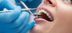 All-On-Four Procedure-tooth-cleaning-925×425-300×138